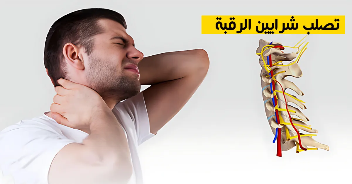 تصلب شرايين الرقبة